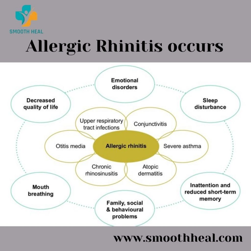 Pediatric Allergic Rhinitis