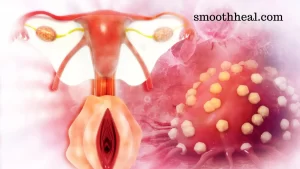 What Causes Cervical Cancer