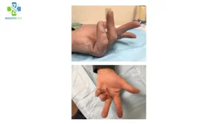 Finger stretching exercises with Xiaflex
