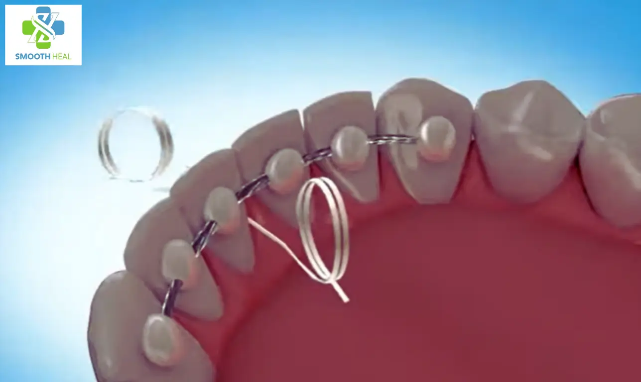 How to Floss with a Permanent Retainer
