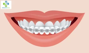 Understanding the Significance of Flossing with a Permanent Retainer