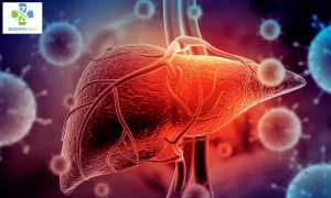 How to Cure Inflamed Liver Disease