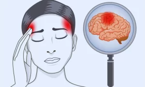 Identifying Headaches Related to Stroke
