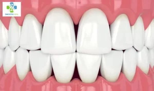 Black Triangle Teeth Home Remedy