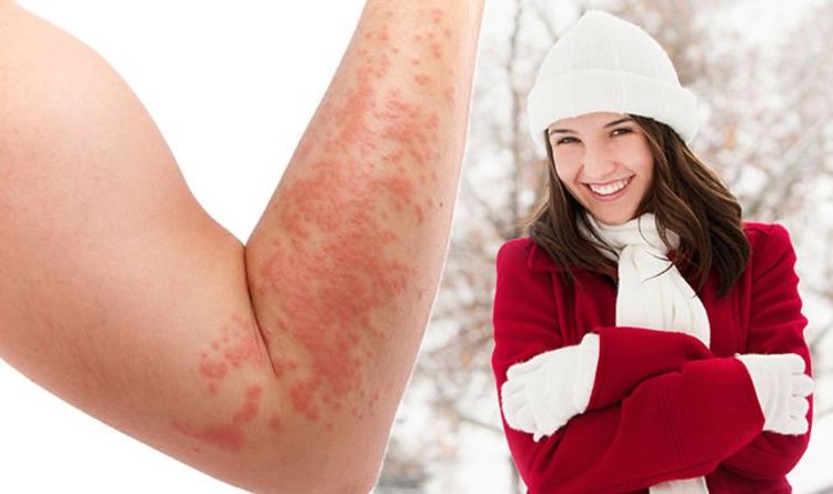 Eczema in Winter